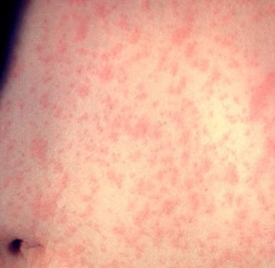 Measles is in the Laurentides; Québec health authority urges vaccination and vigilance