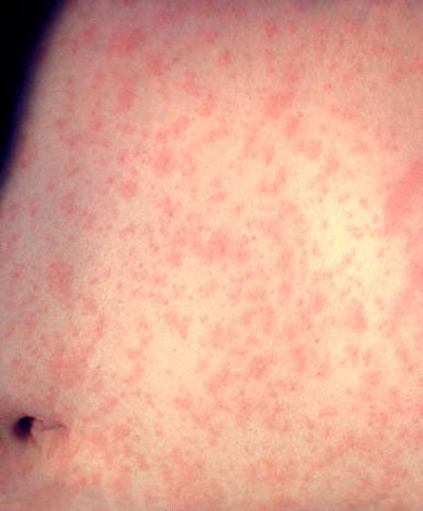 Measles is in the Laurentides; Québec health authority urges vaccination and vigilance